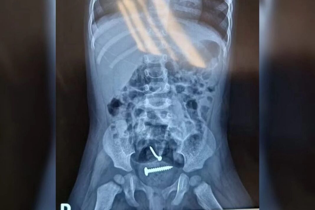 Parafusos são encontrados dentro de criança estuprada pelo pai