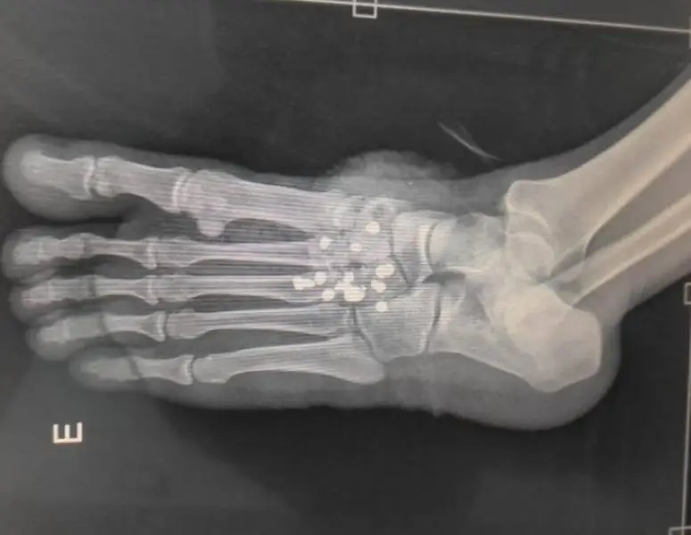 Estranho: adolescente atira no próprio pé e se livra da arma em Vilhena