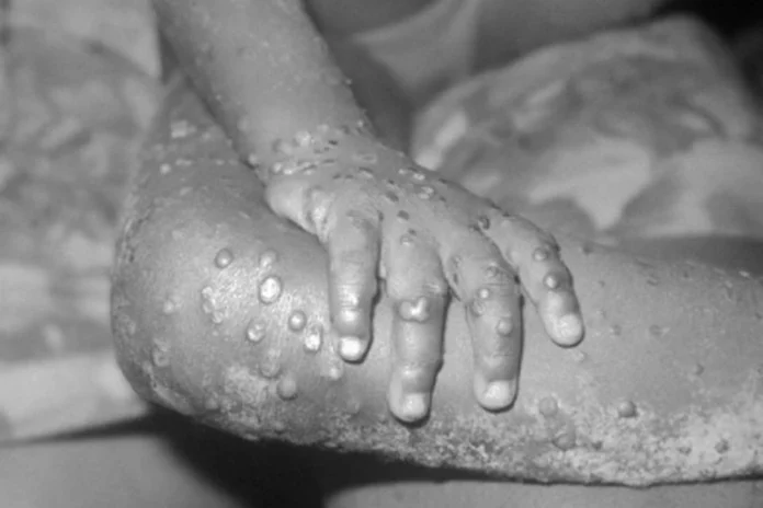 mpox