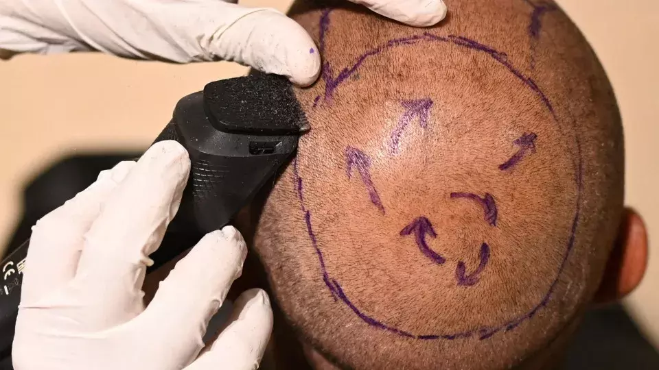 Policial morre após realizar transplante capilar