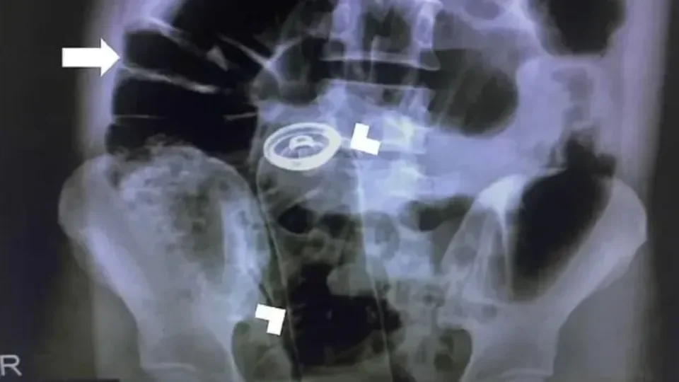 Homem é internado em cidade de Rondônia após introduzir frasco de desodorante no reto