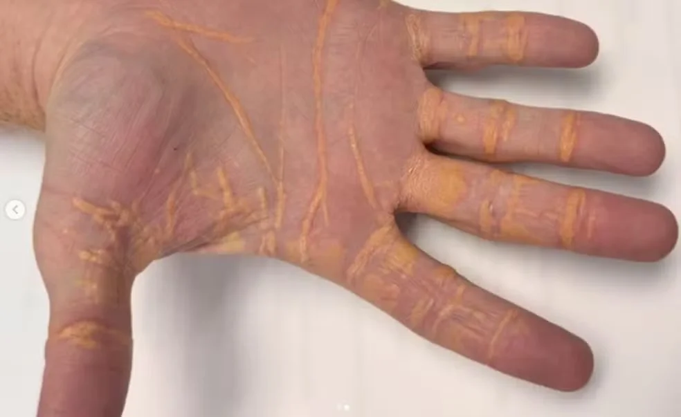 Homem ‘vaza’ colesterol pela mão após dieta carnívora