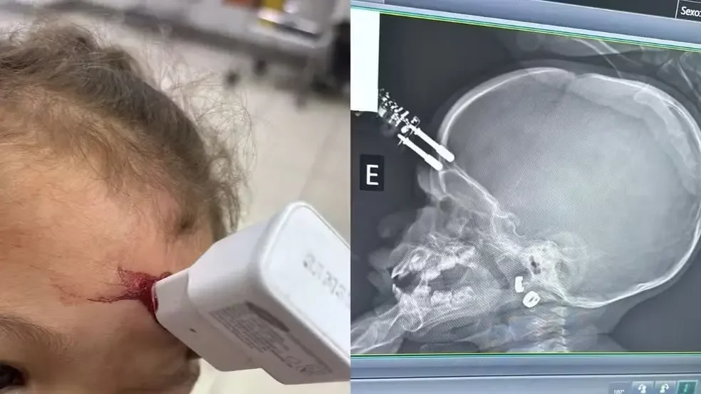 Menina de 1 ano cai da cama e tem carregador cravado na testa