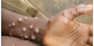 Urgente: confirmado 4 casos de varíola do macaco em RO