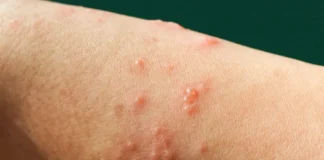 Número de infectados por novo vírus pode ser maior em RO