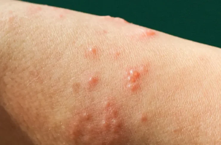 Rondônia reforça vigilância após casos de novo vírus