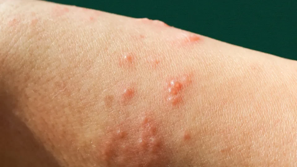 Número de infectados por novo vírus pode ser maior em RO