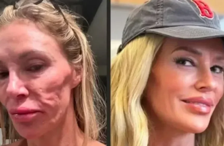 “Derretimento facial” leva influenciadora a 21 médicos